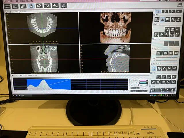 歯科用CT